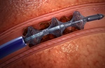 New Technology at Thompson Offers Minimally-Invasive Treatment for Blood Clots