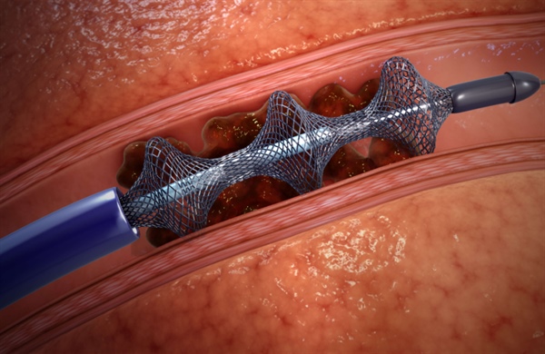 New Technology at Thompson Offers Minimally-Invasive Treatment for Blood Clots