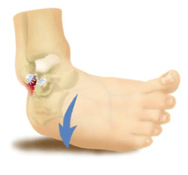 How a Lateral Ankle Inversion Sprain Occurs