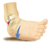 Lateral Ankle Inversion Sprain Illustration