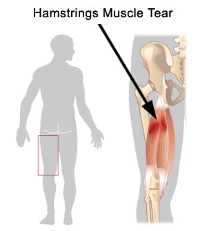 Hamstring Muscle Tear